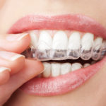 Teeth Whitening - take home custom whitening trays