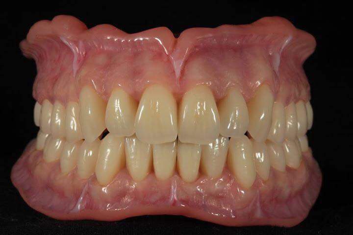 Precision Dentures