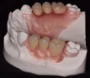 clear partial Dentures 